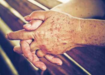 En finir avec les taches brunes